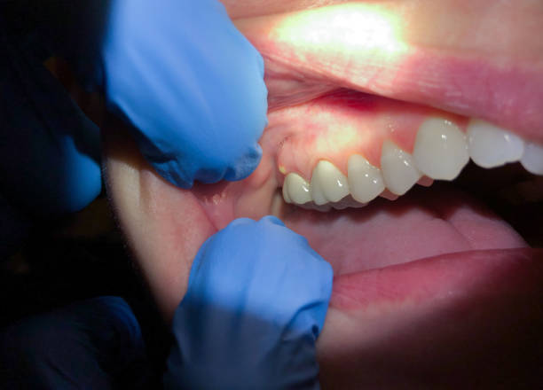 Best Emergency Wisdom Teeth Removal in Garden City, MI